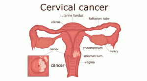 cervix-cancer