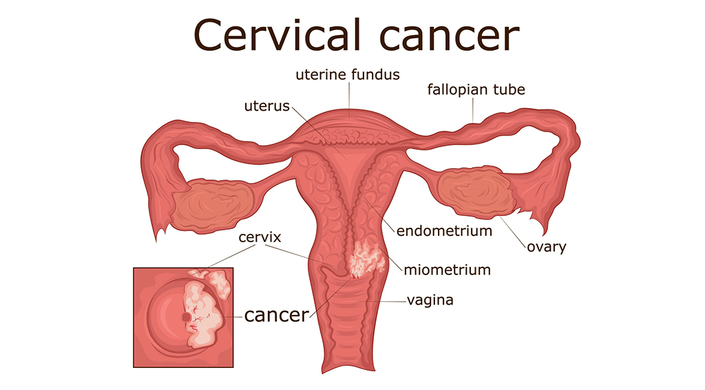 cervix-cancer